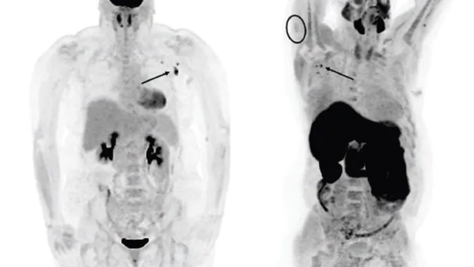 Nach der Covid-19-Impfung auf falsch positive Lymphknoten im PET-Scan achten