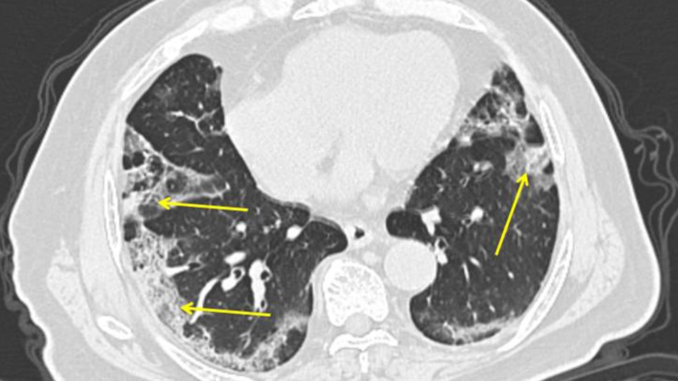 Die wirksamste Methode zur Diagnose von COVID-19: Computertomografie (BT)