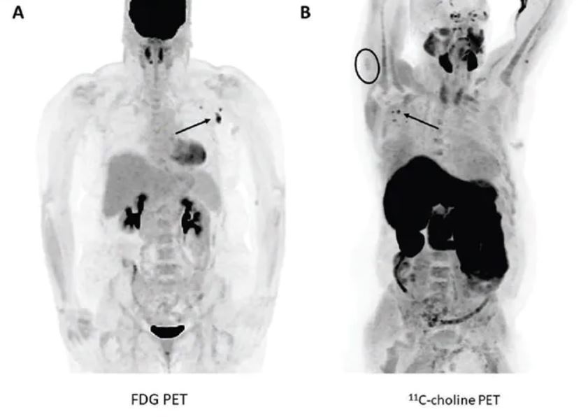Beispielfälle falsch positiver PET-CT-Befunde nach der Covid-Impfung
