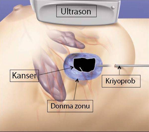 cryoablation kriyoablasyon nasil uygulanir iceball 681413