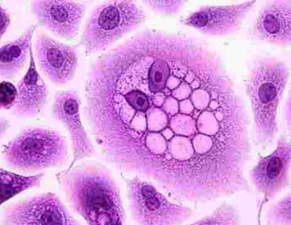 Dentritik Hücre Aşısı Artı Kemoterapi İle Tekrarlamış Over Kanseri Genel Yaşam Süresinde Belirgin Uzama