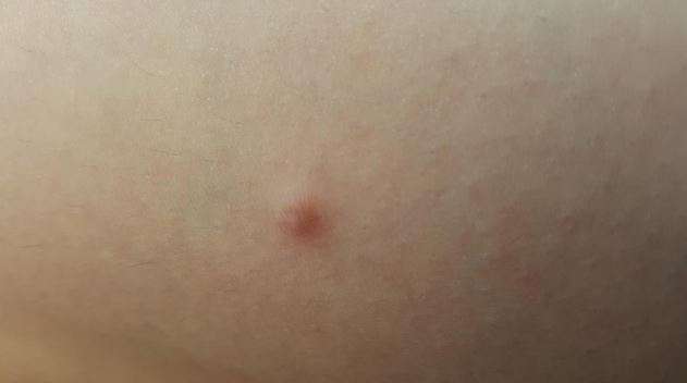 dermatofibrom nedir nasil gozukur 381874