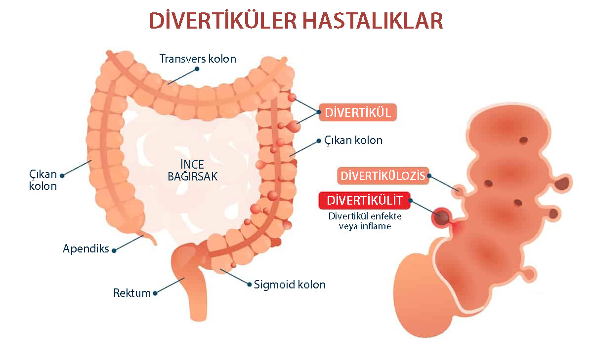 divertikuler hastalik divertukulozis ve divertikulit farklari nedir 437176