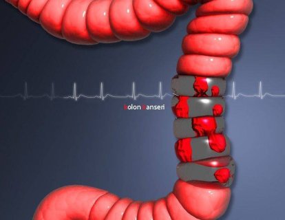 4. Evre Kolon ve Rektum Kanseri İçin Nivolumab FDA Onayı Aldı