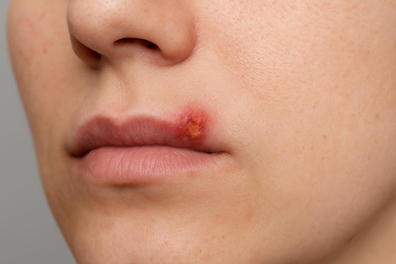 Ursachen von Lippenwunden und mögliche Anzeichen für Lippenkrebs 1