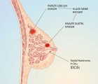 Duktal Karsinoma in Situ (DCIS) Tedavisi – En Yeni Yaklaşımlar ve Kime Ne Gerekli?
