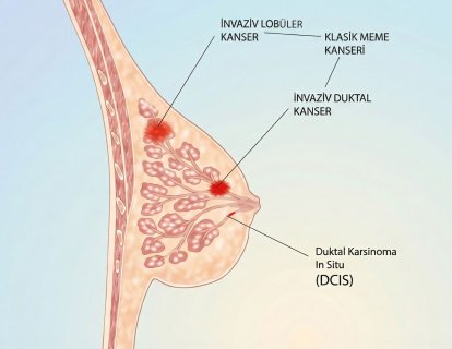 Duktal Karsinoma in Situ (DCIS) Tedavisi – En Yeni Yaklaşımlar ve Kime Ne Gerekli?