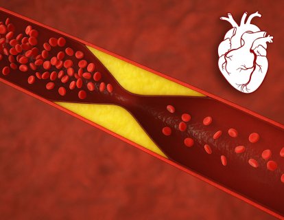 Düşük Doz Kolşisinle Kalp Damarlarındaki Tehlikeli Plaklar Sakinleşiyor