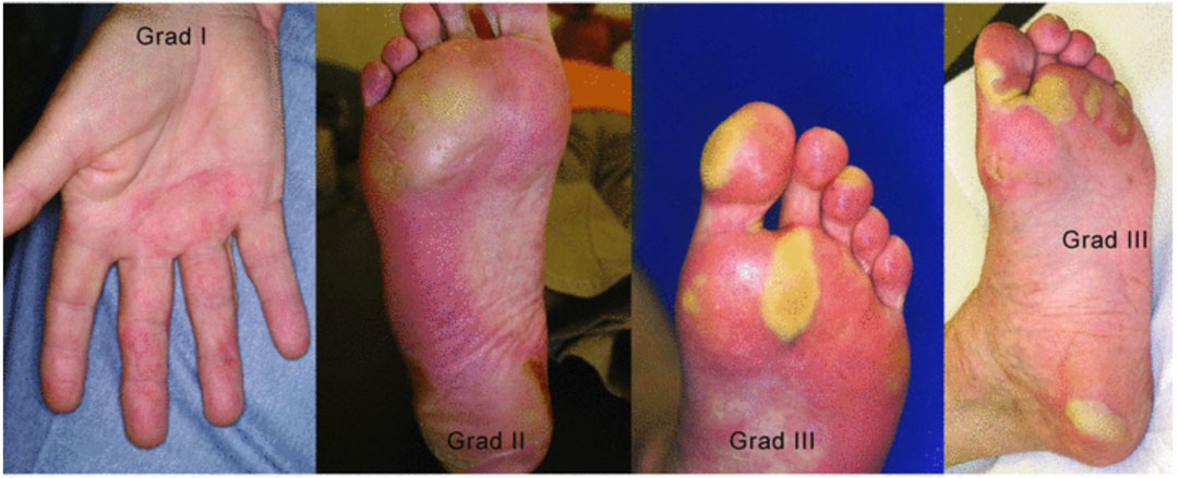 Schweregrade des Hand-Fuß-Syndroms: Grad 1 2 3 4