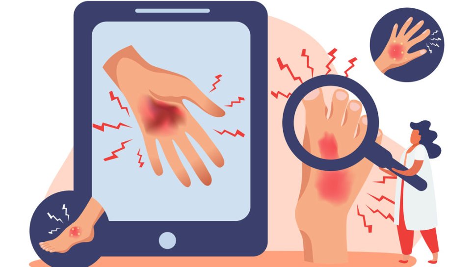Hand-Fuß-Syndrom: Was ist es, warum entsteht es und wie wird es behandelt?