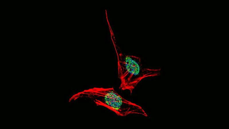 Kanseri Hücrelerinin Tümör Büyümesini Destekleyen Protein Salgıladığı Keşfedildi