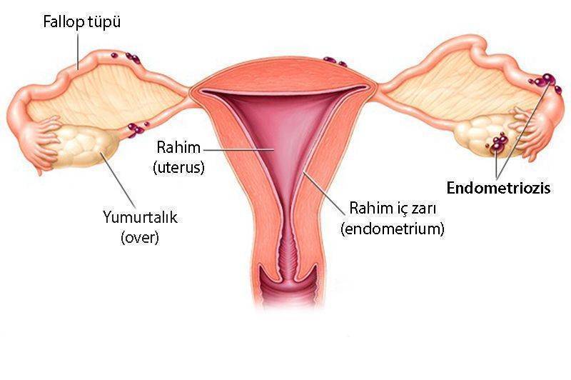 endometriozis nedir nasil olusur rahim uterus yumurtalik over fallop tupu 764498