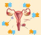 Endometriozis ve Over (Yumurtalık) Kanseri Arasındaki Bağlantı Nedir?
