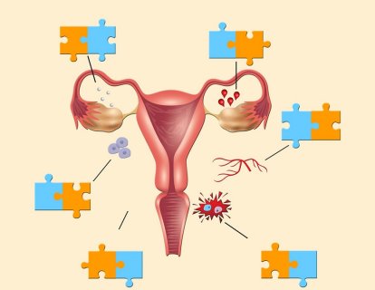 Endometriozis ve Over (Yumurtalık) Kanseri Arasındaki Bağlantı Nedir?
