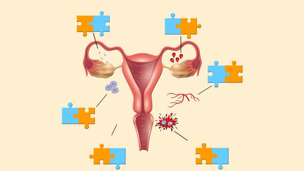 Endometriozis ve Over (Yumurtalık) Kanseri Arasındaki Bağlantı Nedir?