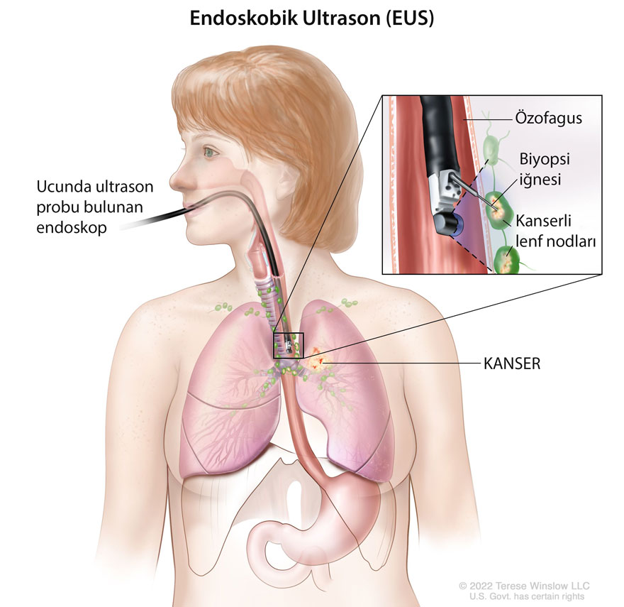 endoskopik ultrason kilavuzlugunda ince igne aspirasyon biyopsisi akciger kanseri 950056