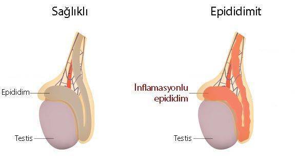 epididimit nedir 310951