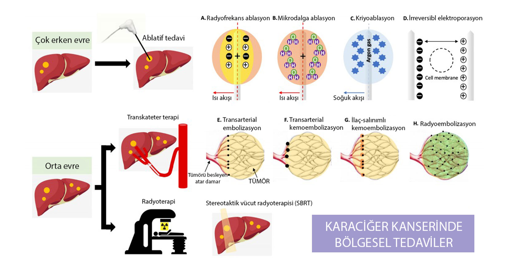 role of local treatments in early-stage hepatocellular carcinoma liver cancer RFA MWA TAE TACE TARE SBRT