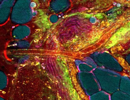 Erken Tanısı Zor Olan Pankreas Kanserini Yüzde 95 Doğrulukla Tespit Eden 2 Yeni Test
