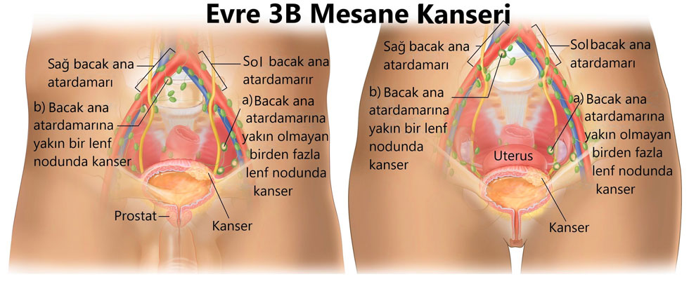evre 3 iiib mesane kanseri 164671