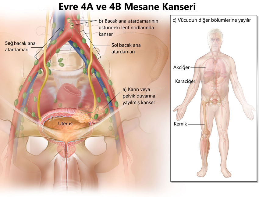 evre 4 iva ve ivb mesane kanseri 348149