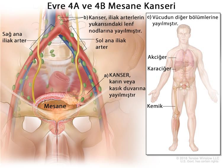 evre 4 metastatik mesane kanseri nedir 457671