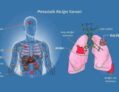 4. Evre Kanser, Metastaz ve Metastatik Nedir, Metastaz Belirtileri, Kanser Neden Metastaz Yapar?