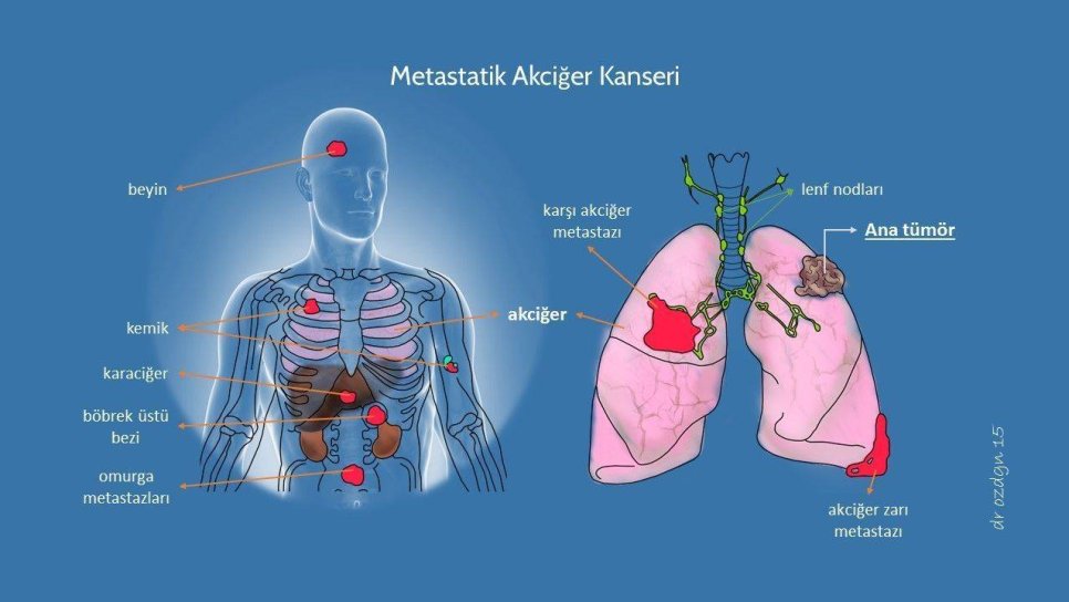 4. Evre Kanser, Metastaz ve Metastatik Nedir, Metastaz Belirtileri, Kanser Neden Metastaz Yapar?