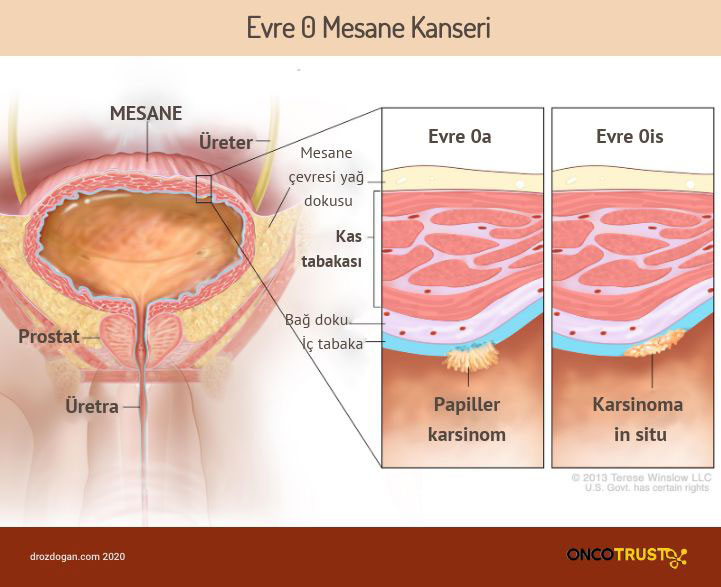 evre sifir mesane kanseri 893828