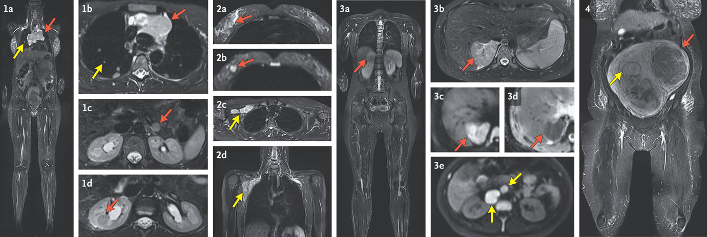 farkli kanser turleri ve benign durumlarin mrg taramalarindaki karakteristik bulgulari 903091