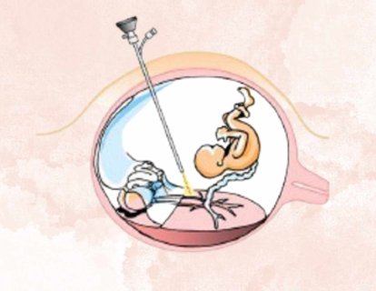 Fetal Cerrahi 1981 – Anne Karnındaki Bebeğin Ameliyat Edilmesi
