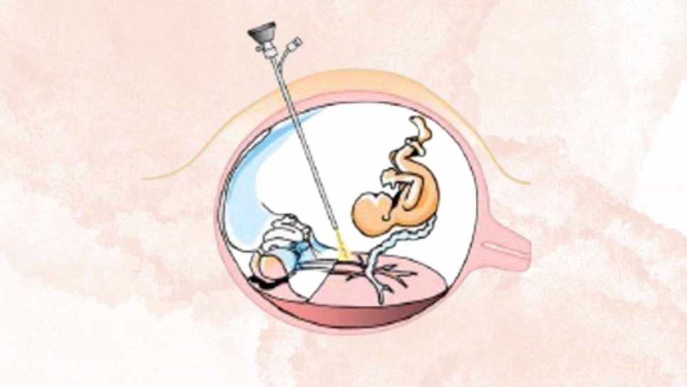 Fetalchirurgie 1981 – Operationen am Baby im Mutterleib