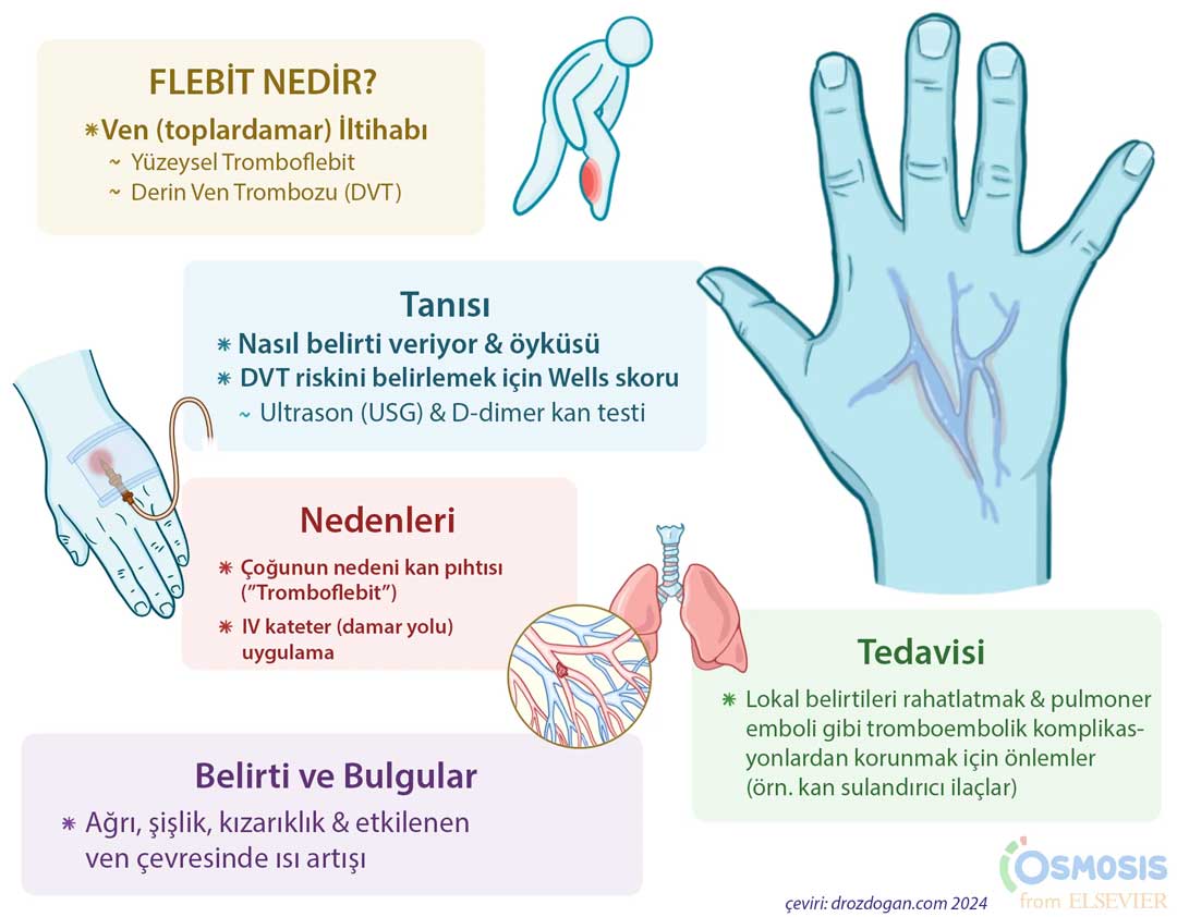 An illustrated explanation of phlebitis