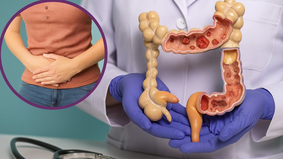 Kolon Kanserinde FOLFİRİ ve Altuzan (Bevasizumab) Tedavi Rejimi