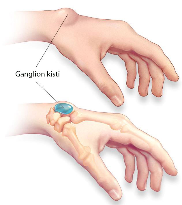 ganglion kisti nedir el bilegi 434672