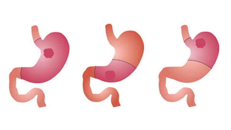 How Should Patients Eat After Gastrectomy (Stomach Cancer Surgery)?