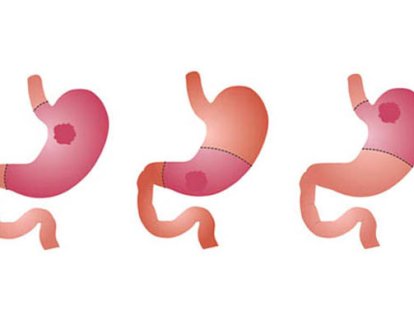 Gastroktemi (Mide Kanseri Ameliyatı) Olan Hastalar Nasıl Beslenmeli?