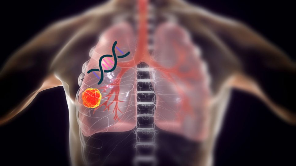Profilul genetic determină riscul de cancer pulmonar al fumătorilor