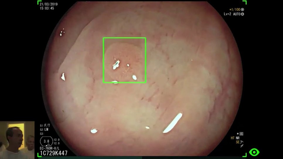 FDA Approves the First Device Using Artificial Intelligence for Early Detection of Colon Cancer