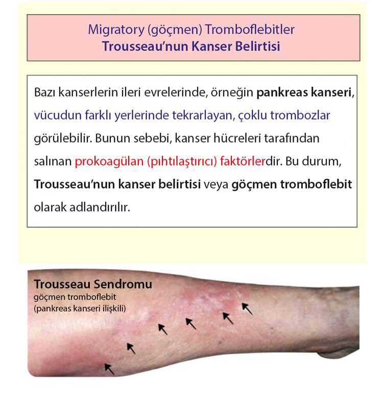 köçəri tromboflebitlər Trousseau sindromu