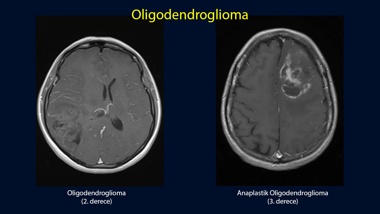 grade 2 ve 3 oligodendroglioma nedir karsilastirma 215439
