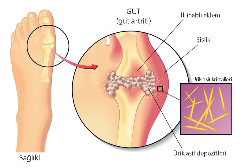 What is gouty arthritis, uric acid accumulation