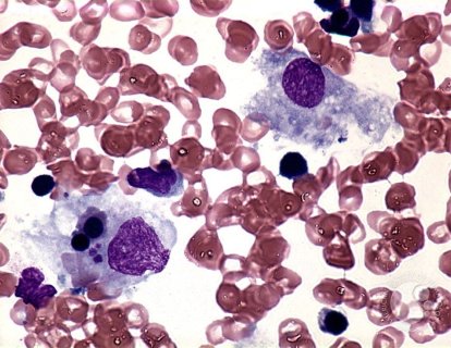 Hemofagositik lenfohistiyositoz tedavisi için Emapalumab FDA onayı aldı