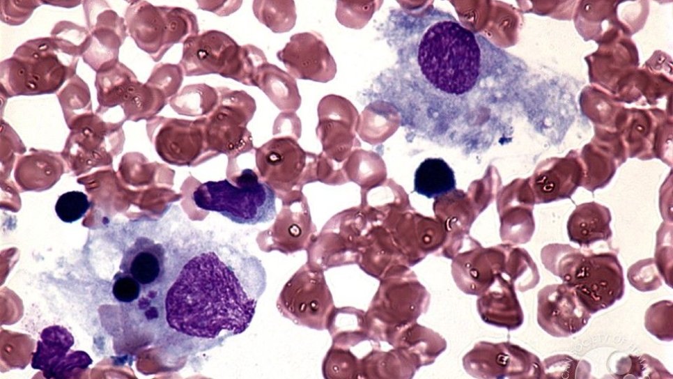 Hemofagositik lenfohistiyositoz tedavisi için Emapalumab FDA onayı aldı