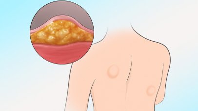 Yağ Bezesi Kanser midir? Ne Zaman Doktora Başvurulmalı?