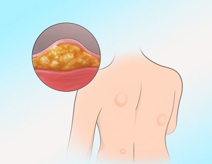 Yağ Bezesi Kanser midir? Ne Zaman Doktora Başvurulmalı?