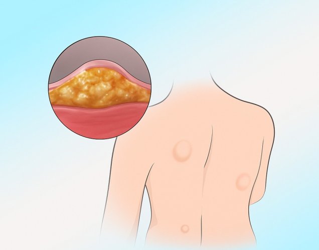 Yağ Bezesi Kanser midir? Ne Zaman Doktora Başvurulmalı?