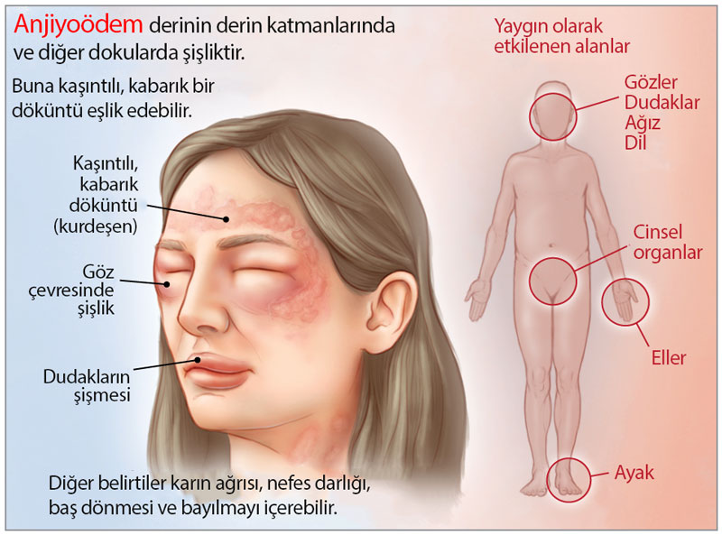 İrsi angioödemli xəstə nümunəsi: infoqrafika