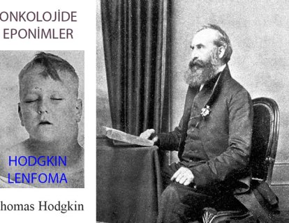 Hodgkin Lenfoma Nedir? Adı Nereden Gelmektedir?