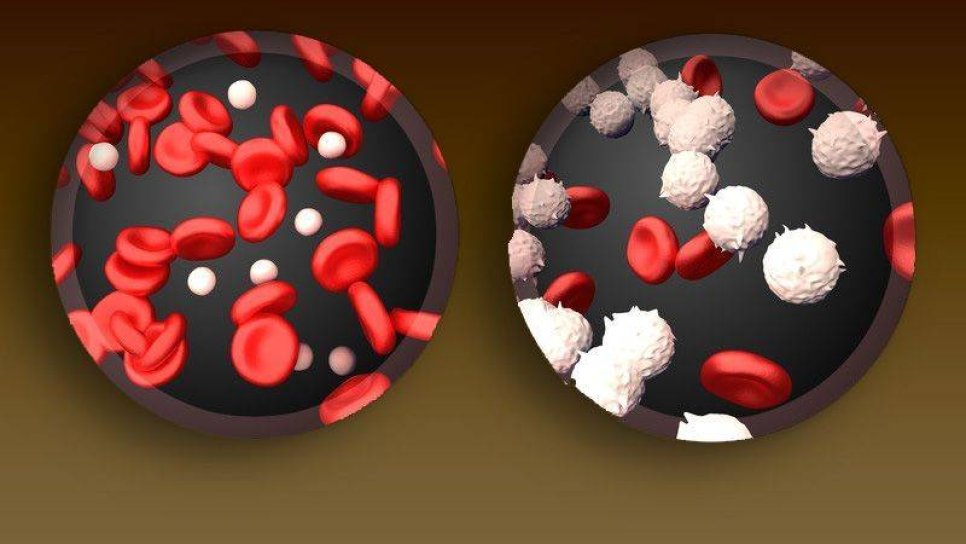 Akut Miyeloid Lösemi Tedavisi İçin Enasidenib FDA Onayı Aldı